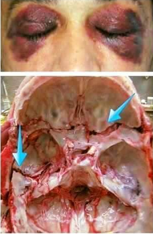 skull fracture eye basal raccon raccoon medicaltalk medical subgaleal