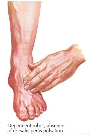 Diabetic Foot Ulcers: Practice Essentials, Cause, Pathophysiology