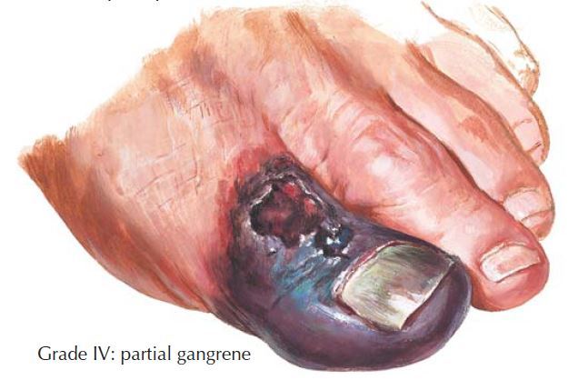 Diabetic Foot Ulcers: Practice Essentials, Cause, Pathophysiology