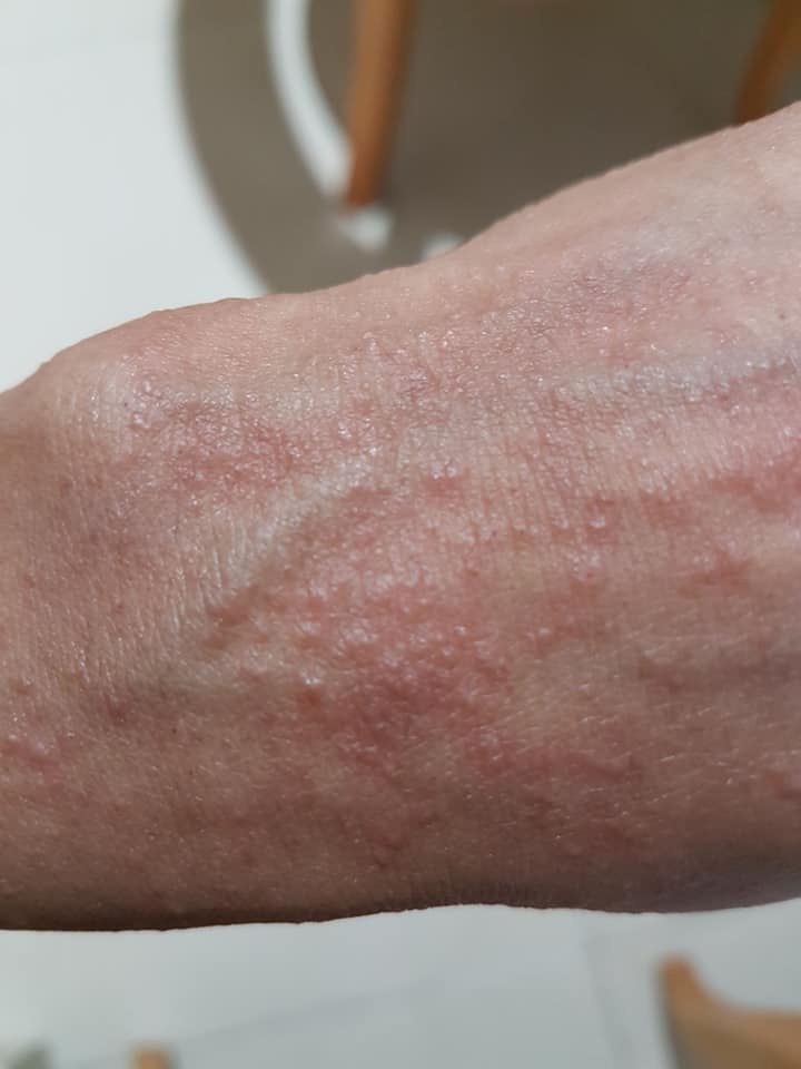 Small Itchy Bumps On Skin Drbeckmann