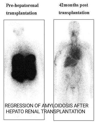 Regression%20of%20amyloidosis%20after%20hepatorenal%20transplantation