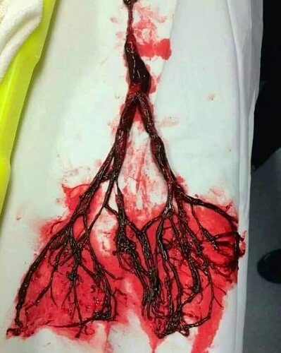 Blood%20Clot%20Removed%20from%20Lungs