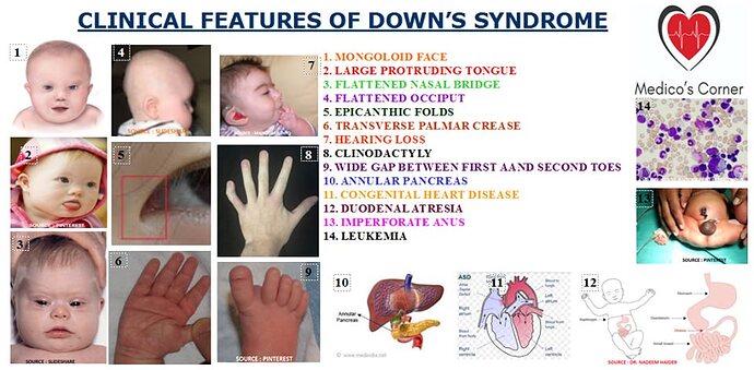 Clinical%20Features%20of%20Down%20Syndrome