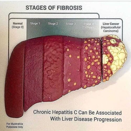 Stages%20of%20Fibrosis