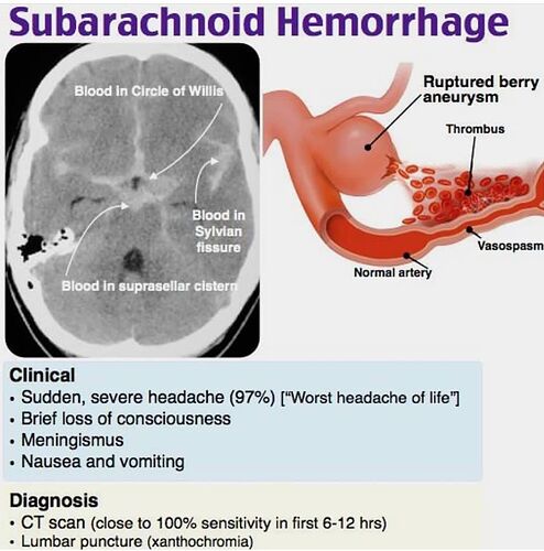 Subarachnoid%20Hemorrhage