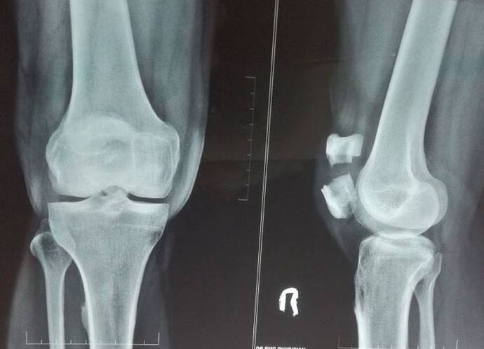 Definitive treatment of the fracture in the Xray is