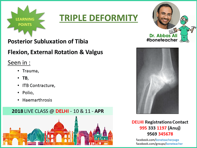 Posterior subluxation of tibia flexion external rotation valgus