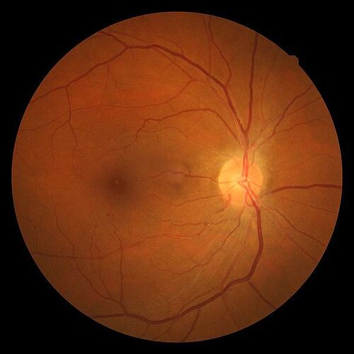 Fundus picture in hypertensive retinopathy