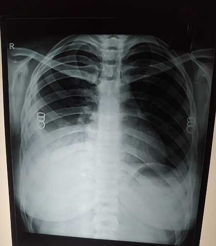Any comment on the xray