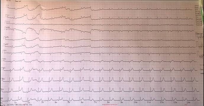 Can someone help me to diagnose this ECG.