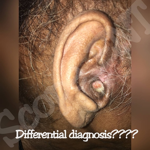 A 62 year female complaining of right ear discharge since 4 months with on and off ear pain