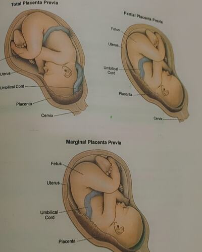 Placenta Previa Types!!!! Obstetric Emergencies!!