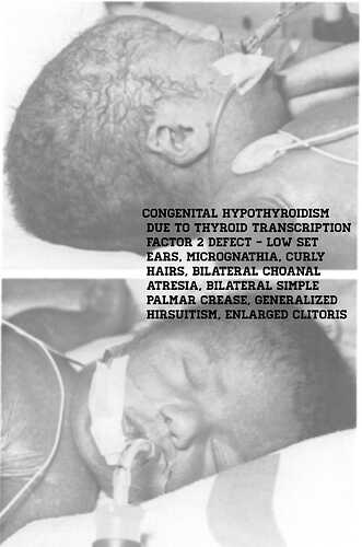 Congenital Hypotyroidism