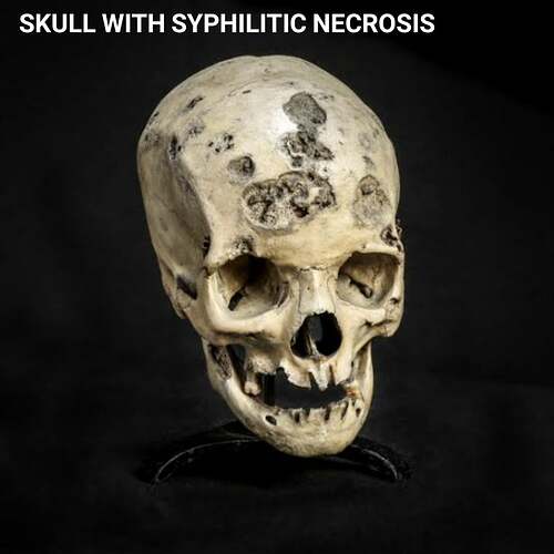 Skull with syphilitic  necrosis