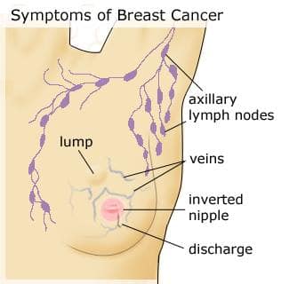 Early%20Signs%20Of%20Breast%20Cancer