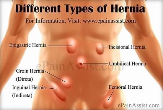 Different%20Types%20of%20Hernia