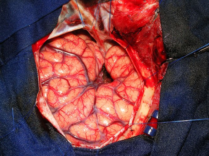 is_150629_brain_tumor_surgery_800x600