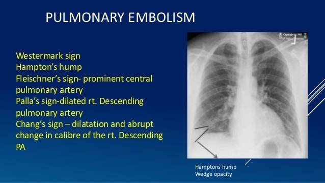 Pulmonary%20Embolism