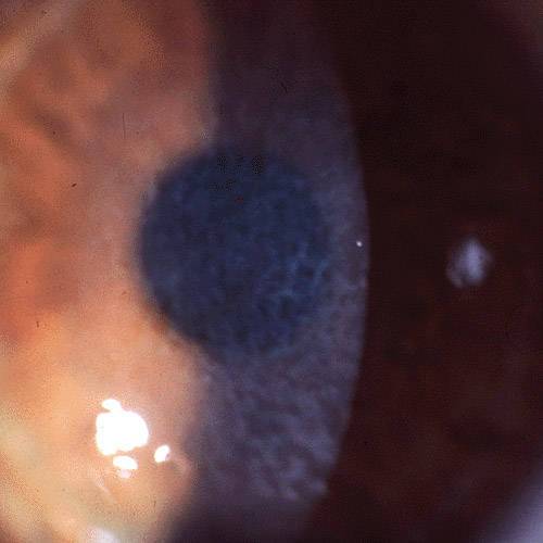 reticular opacity of the cornea