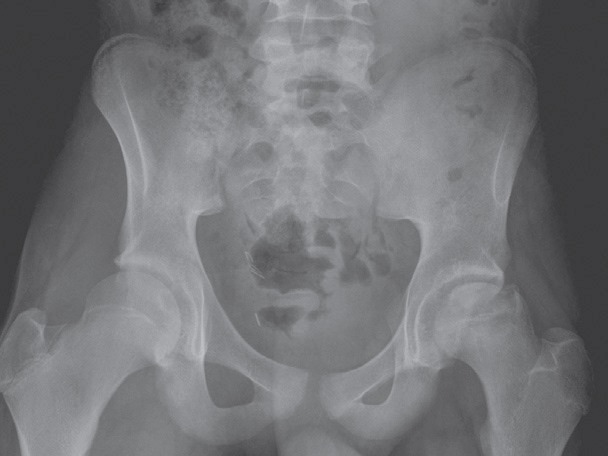 Avascular Necrosis Of Bilateral Femoral Heads Radiology MedicalTalk Net The Best