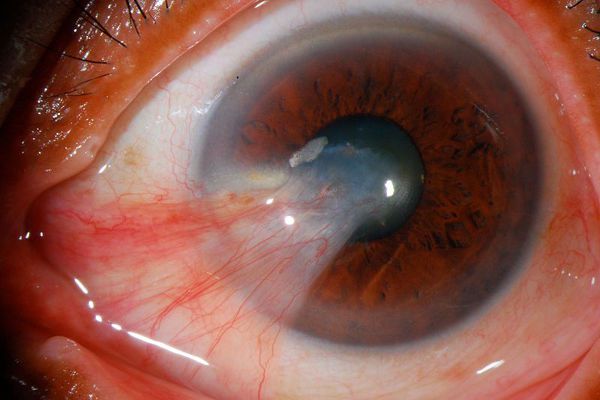 Pterygium extending into pupillary area