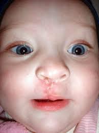 Cleft%20lip%20and%20cleft%20palate%20are%20birth%20defects1