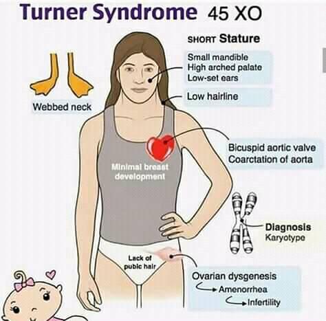 Turner%20syndrome%2045%20XO