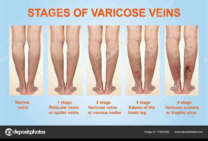 Stages%20of%20varicose%20veins