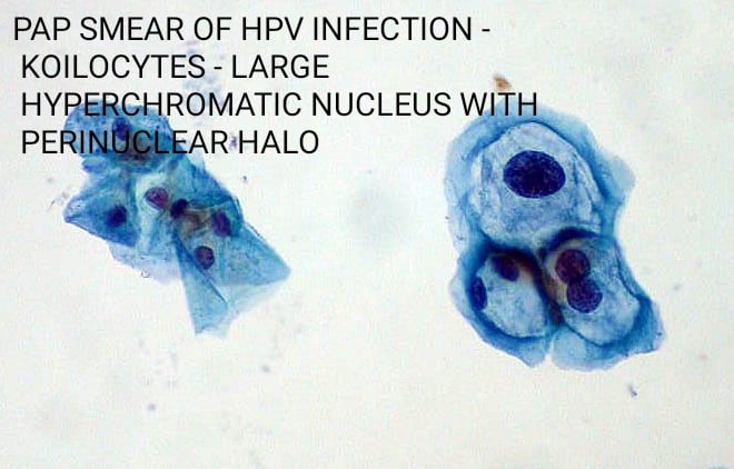 Pap smear of HPV infection