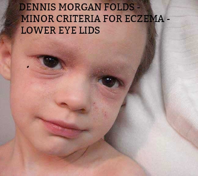 Dennis morgan folds minor criteria