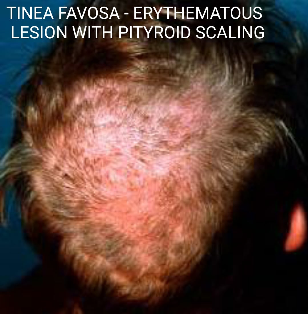 Tinea Favosa Erythematous lesion with pityroid scaling - NEET PG - www ...