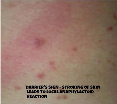 Darriers sign stroking of skin