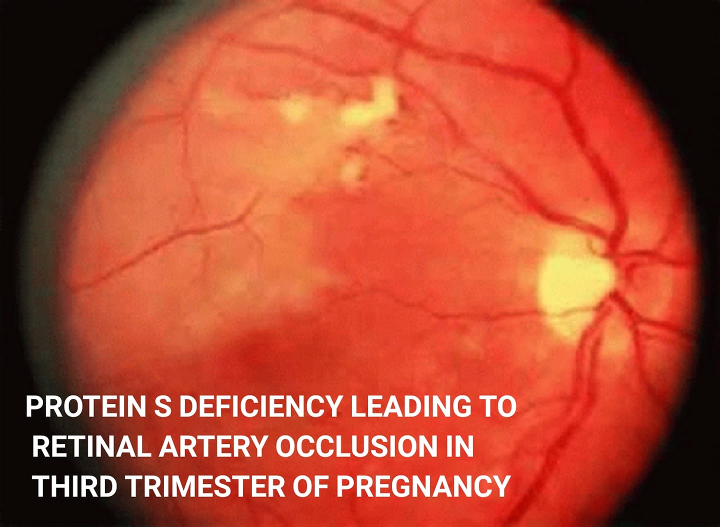 Proteins deficiency leading to retinal artery occlusion in third trimester